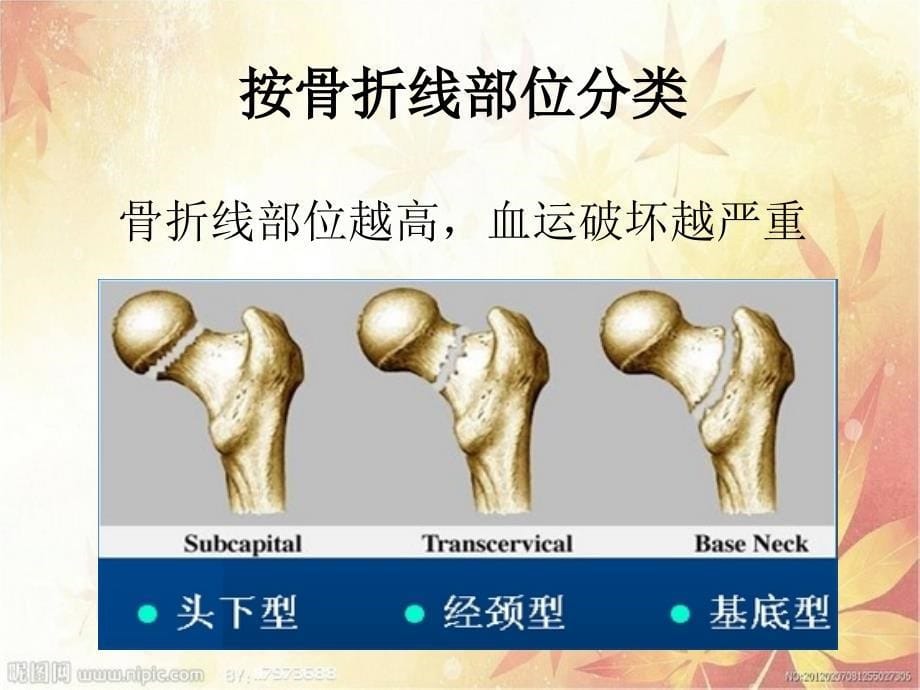 股骨颈骨折合并糖尿病的护理课件_第5页