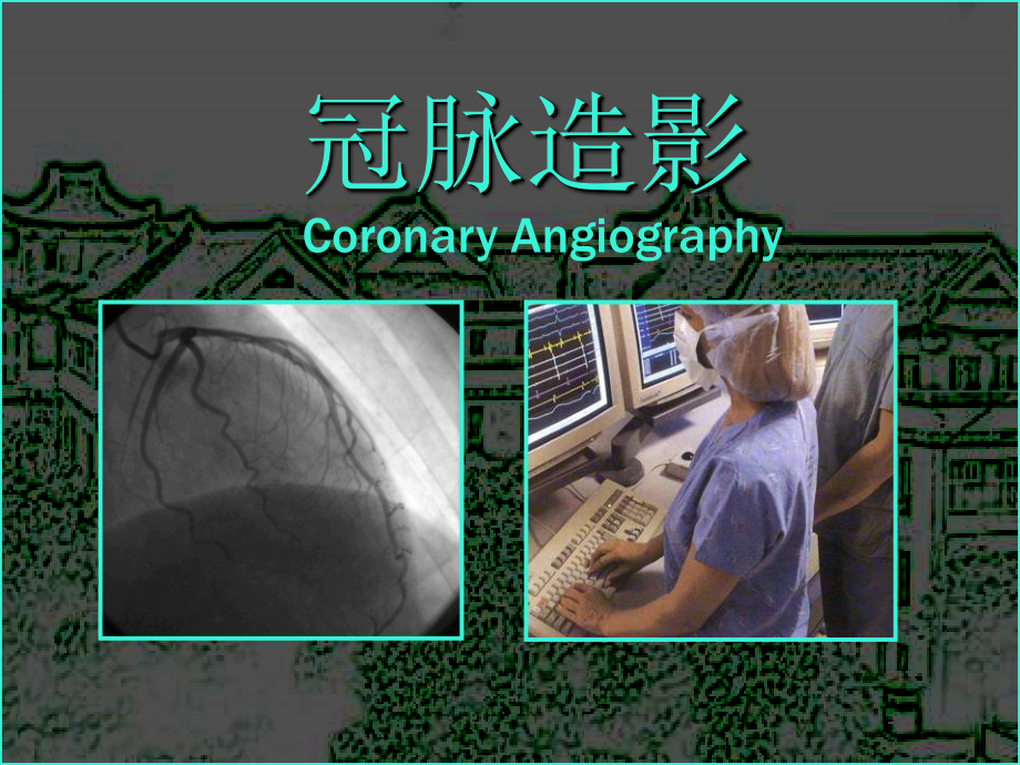 通城县人民医院冠状动脉造影课件_第2页