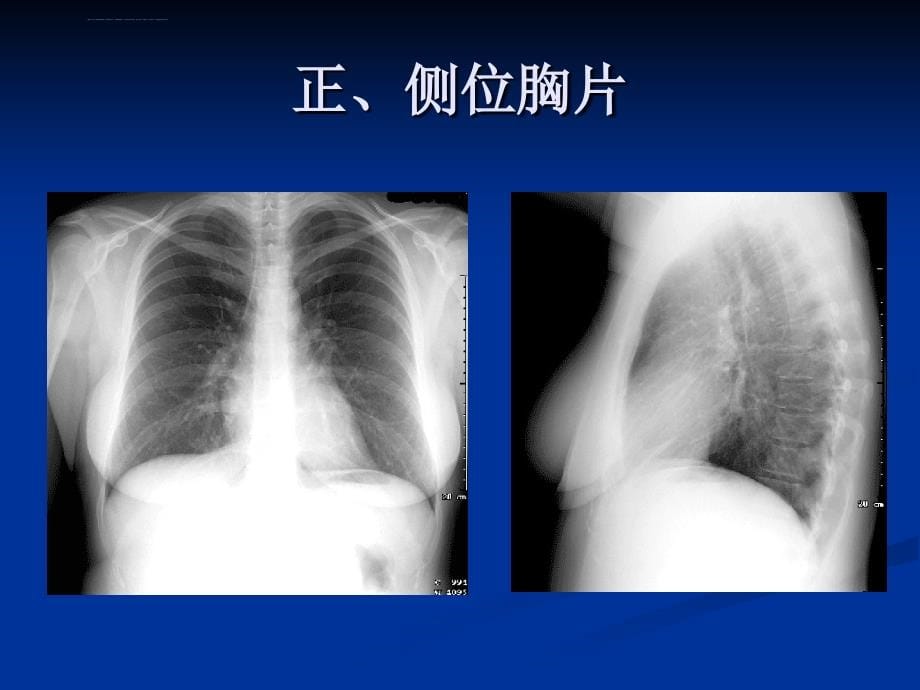 胸部x阅片常规(克州医院业务学习)课件_第5页