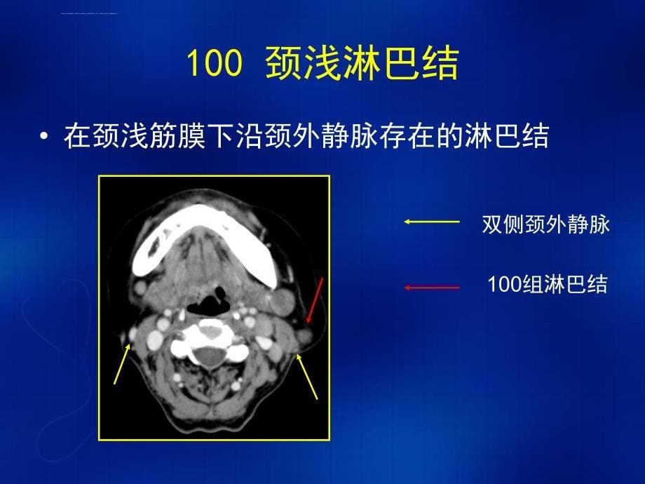 胸腔淋巴结的ct分区课件_第5页