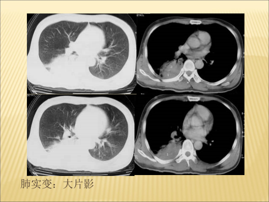 胸部基本病变课件_第2页