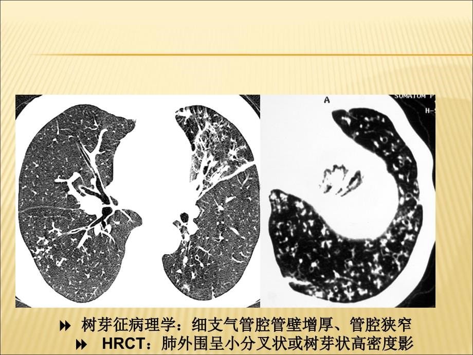 胸部基本病变课件_第5页