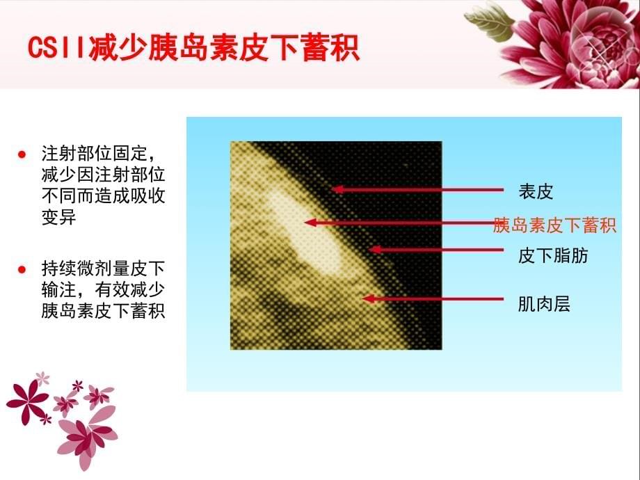 胰岛素泵的使用及维护课件_第5页