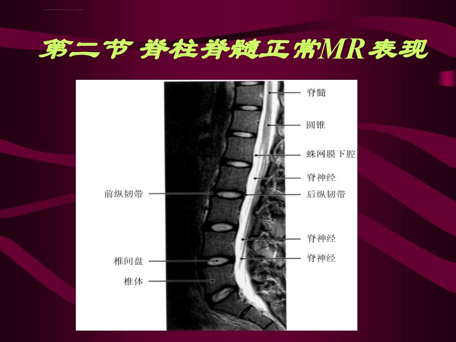 脊柱和脊髓病变mri诊断课件_第4页