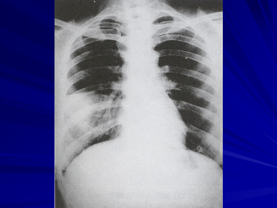 呼吸病学-肺部感染性疾病课件_第2页