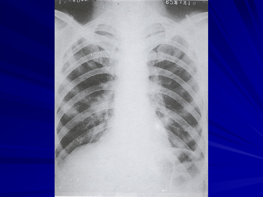 呼吸病学-肺部感染性疾病课件_第3页
