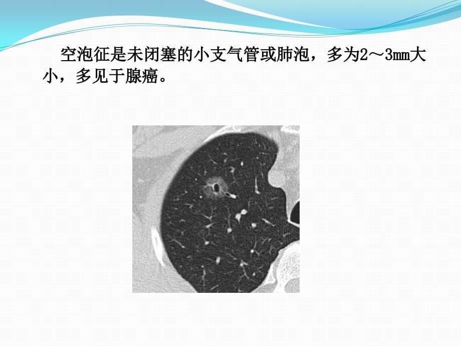 胸腔镜下肺部手术的护理配合课件_第5页