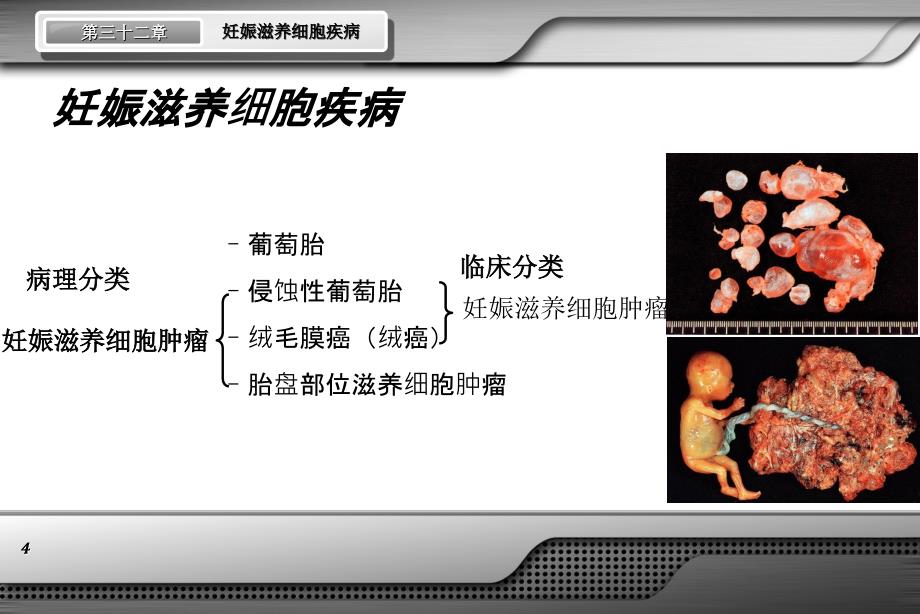 妊娠滋养细胞疾病ppt妇产科课件_第4页