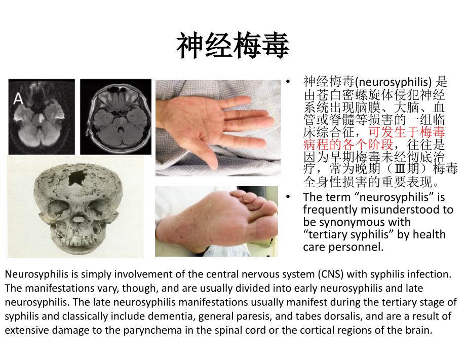 金庆文中枢神经系统螺旋体病诊疗进展课件_第3页