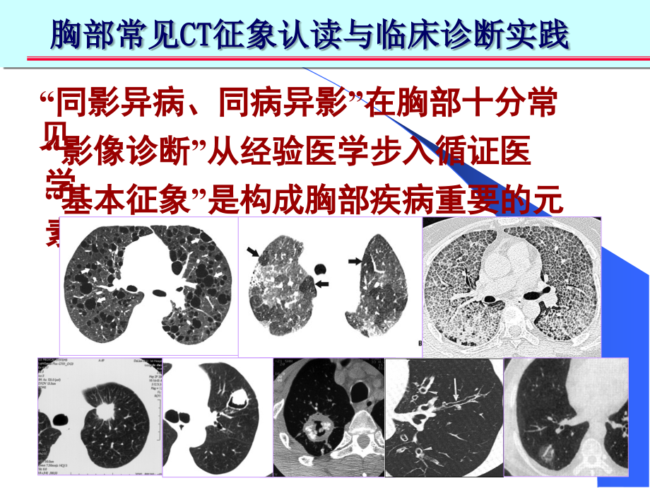 肺部ct十大征象诊断应用资料ppt课件_第2页
