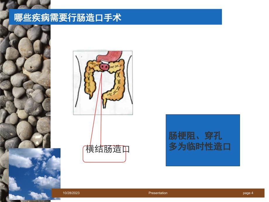 直肠癌的治疗及护理课件_第4页