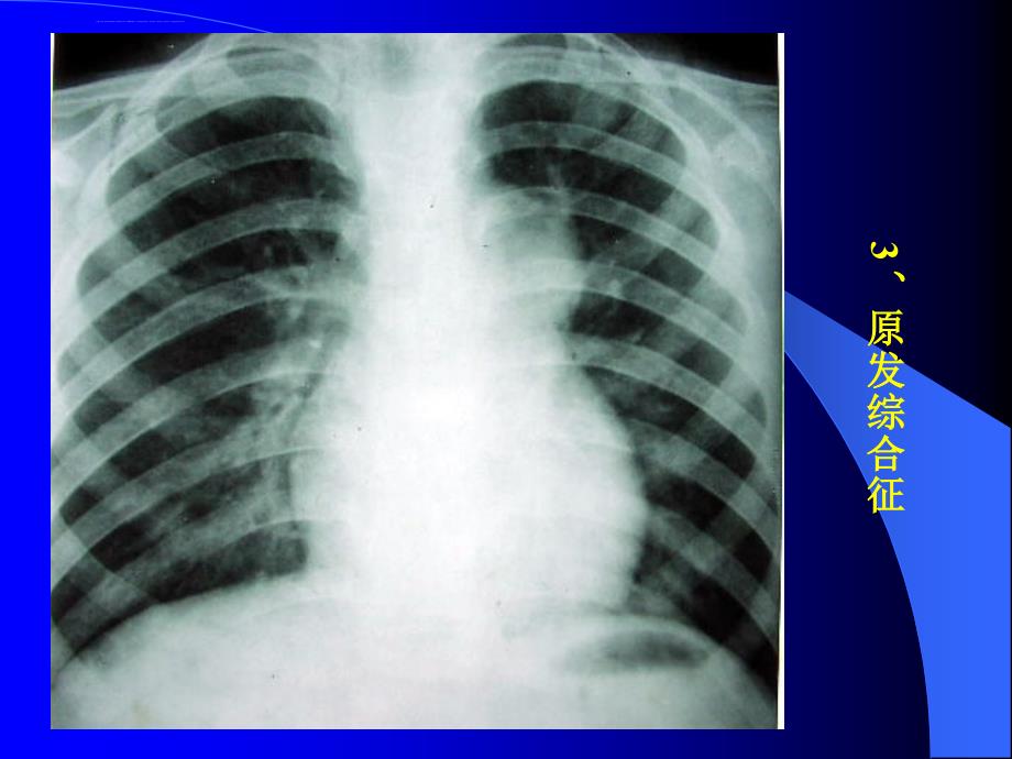 胸部x片、ct读片课件_第4页