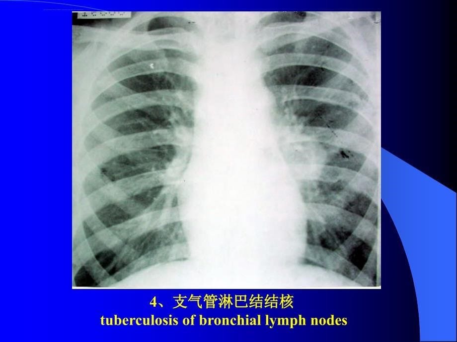 胸部x片、ct读片课件_第5页