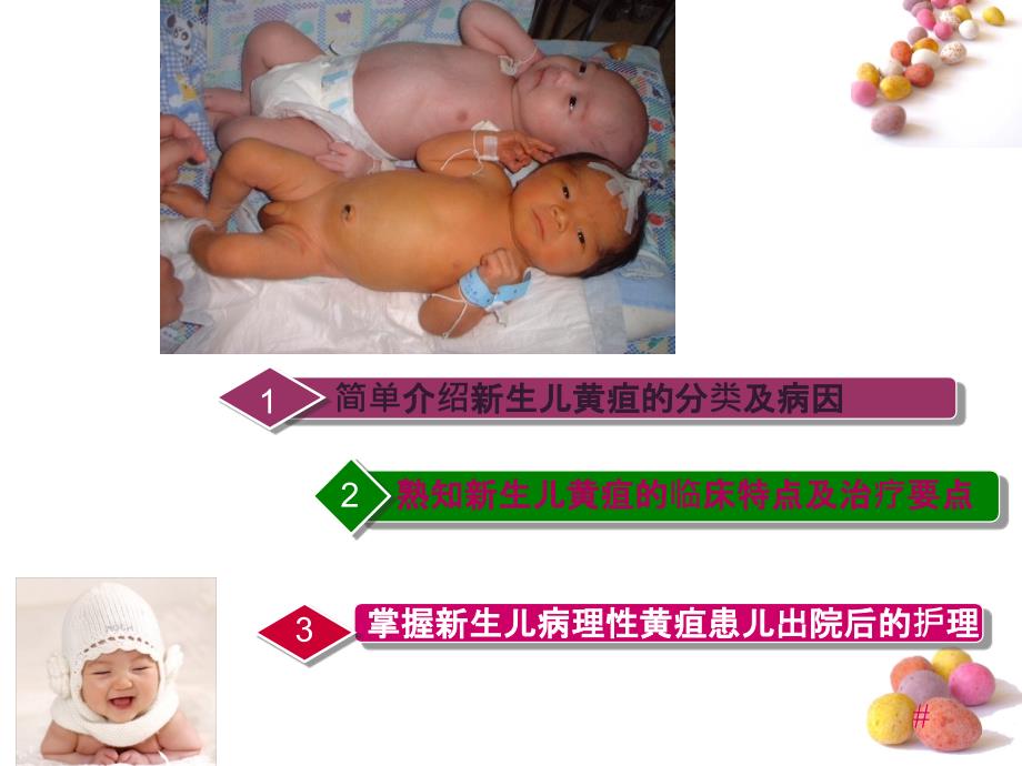 新生儿黄疸的护理最终版_第2页