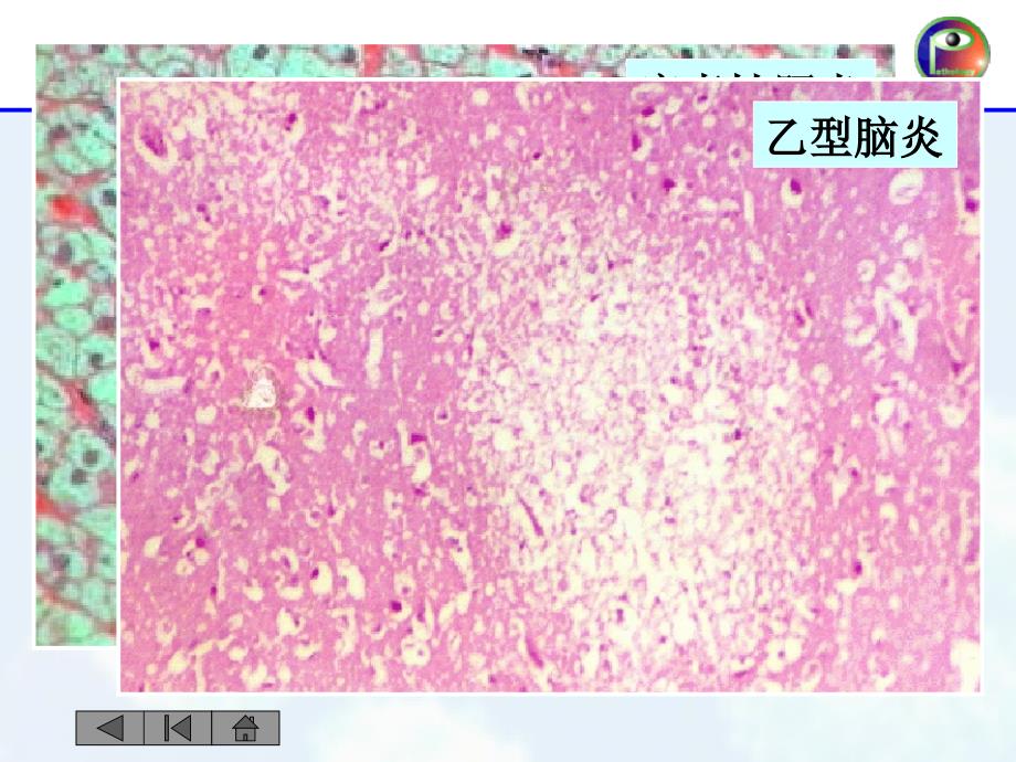 炎症的类型ppt-病理学课件_第4页