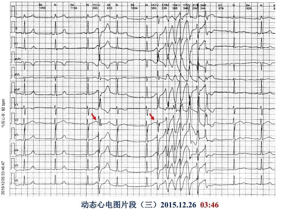 短联律间期tdp课件_第5页