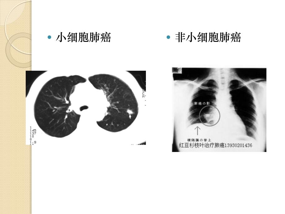 肺癌健康教育课件_第4页