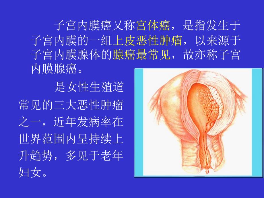 妇产科课件-子宫内膜癌课件_第2页