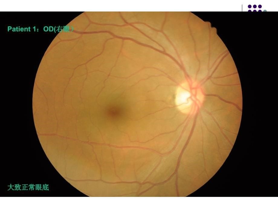 糖尿病和高血压眼底检查课件_第5页