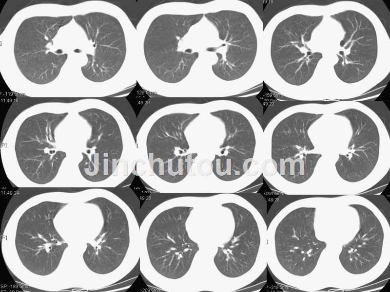 肺部ct见习阅片课件_第5页