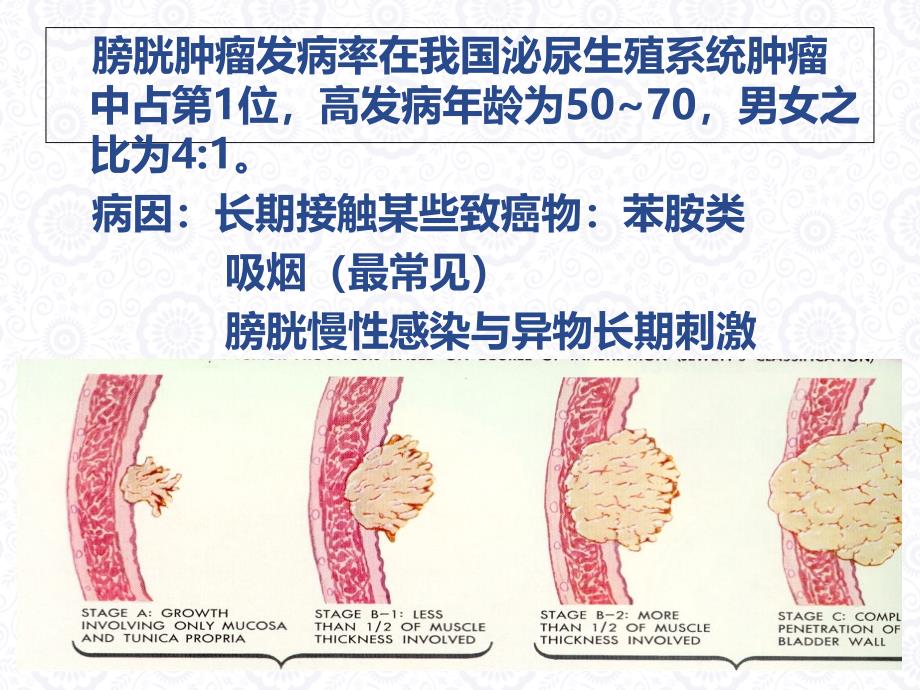 泌尿1：一例膀胱肿瘤患者护理查房--王莉_第3页