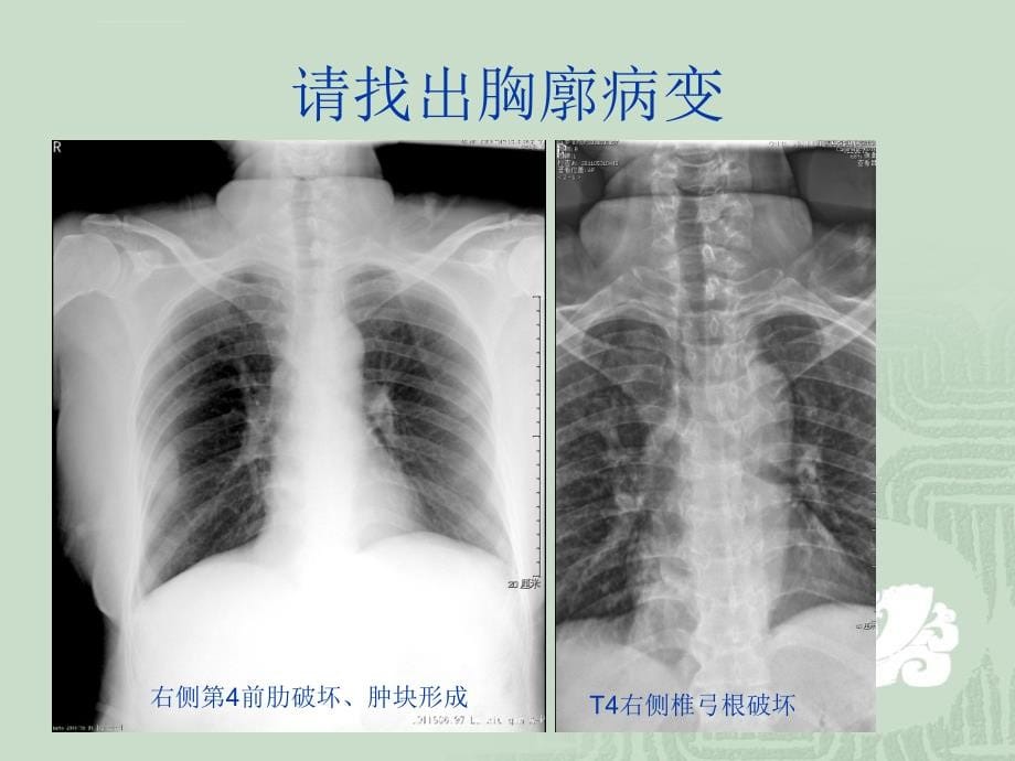 胸片读片入门课件_第5页