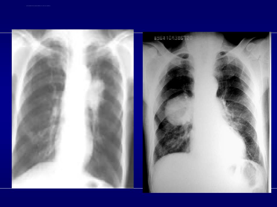 肺癌综合治疗课件_第4页