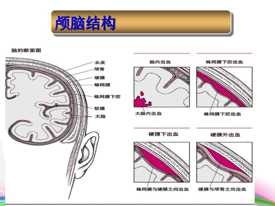 颅内血肿的护理课件_第5页