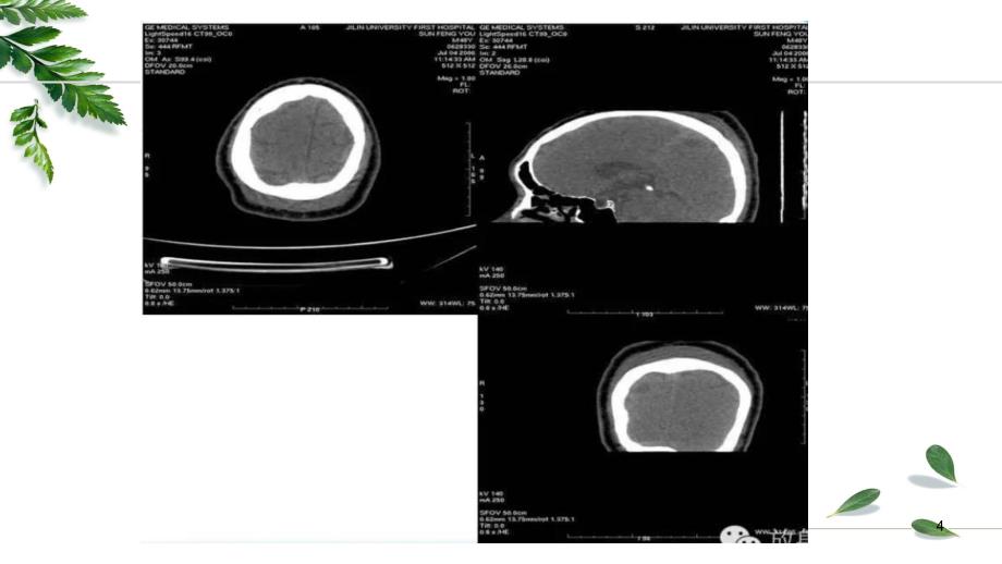 颅脑外伤的ct诊断-改课件_第4页