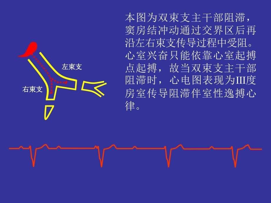 房室传导阻滞-ppt诊断学课件_第5页