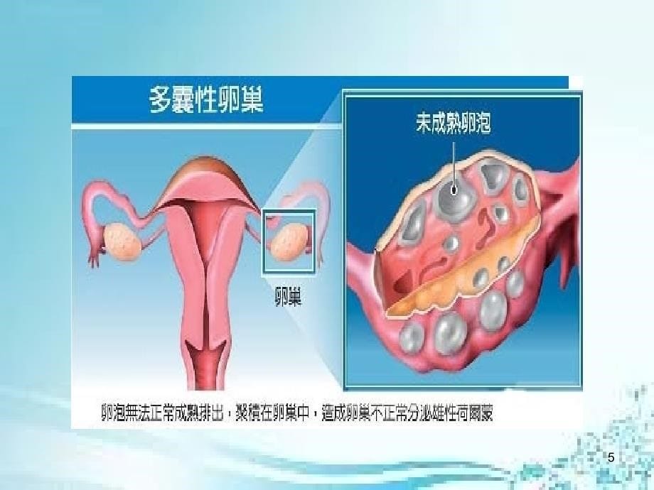 多囊卵巢综合症（pcos）_第5页