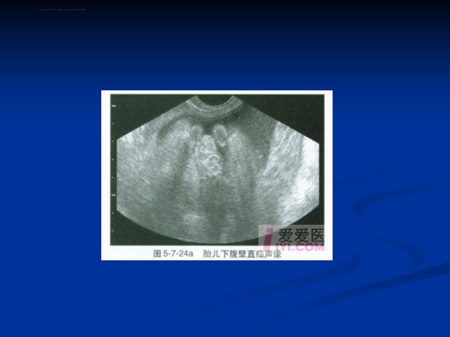 胎儿骨骼系统发育异常超声诊断系列课件_第3页