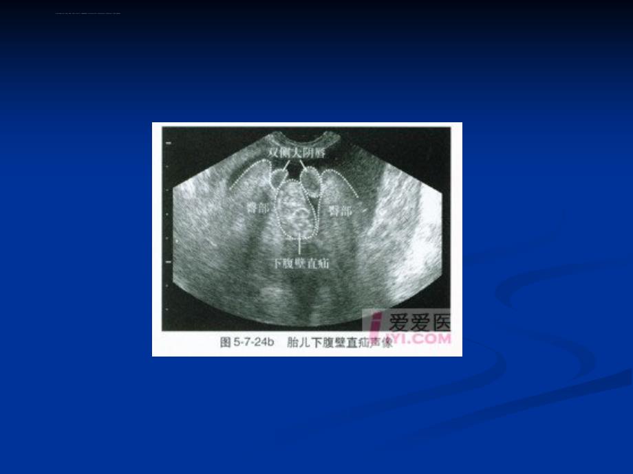胎儿骨骼系统发育异常超声诊断系列课件_第4页