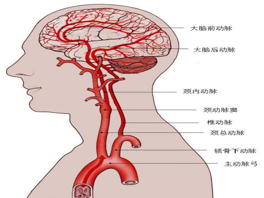 脑血管病护理_第3页