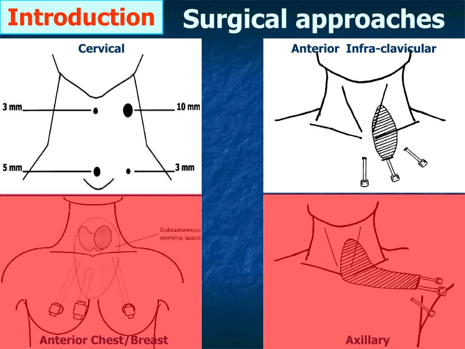 腔镜下甲状腺切除术endoscopic-thyroidectomy--2012年5月-腹腔镜学习班----胸乳入路_第3页