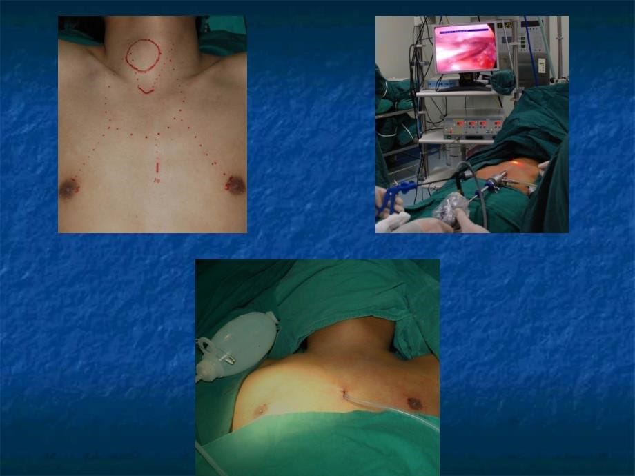 腔镜下甲状腺切除术endoscopic-thyroidectomy--2012年5月-腹腔镜学习班----胸乳入路_第5页