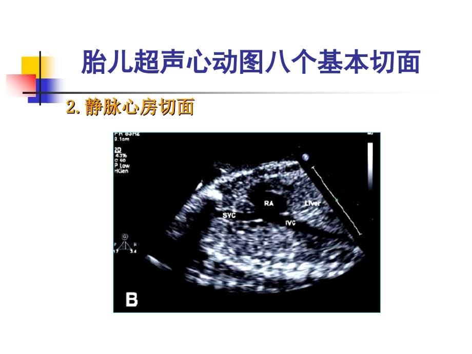 胎儿心脏异常的超声诊断课件_第5页