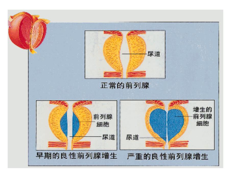 药综-十四章-前列腺增生症_第3页