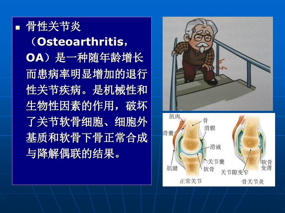 膝关节骨性关节炎的诊断及治疗_第2页