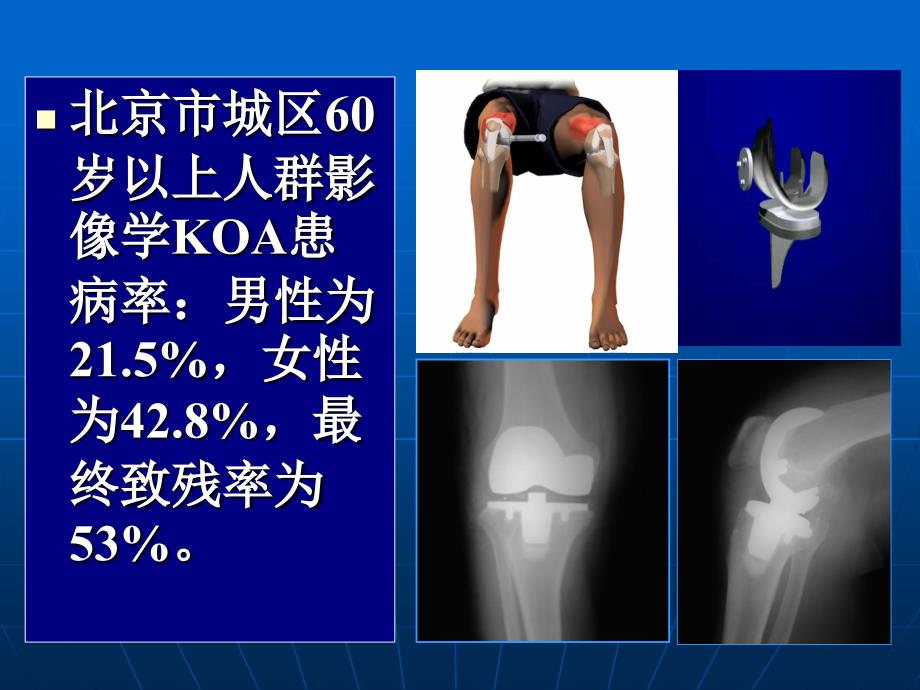 膝关节骨性关节炎的诊断及治疗_第4页