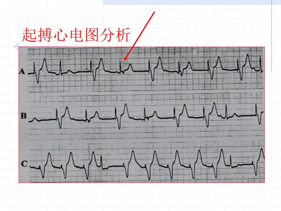 起搏心电图分析课件_第4页