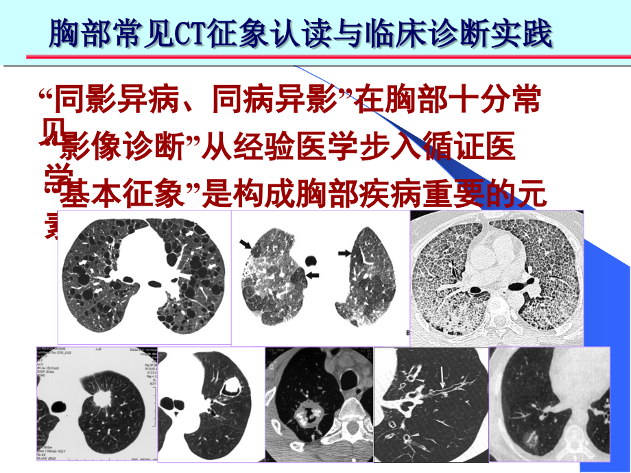 胸部ct十大征象诊断应用课件_第2页