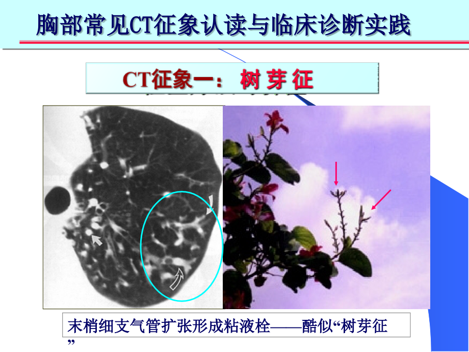 胸部ct十大征象诊断应用课件_第4页