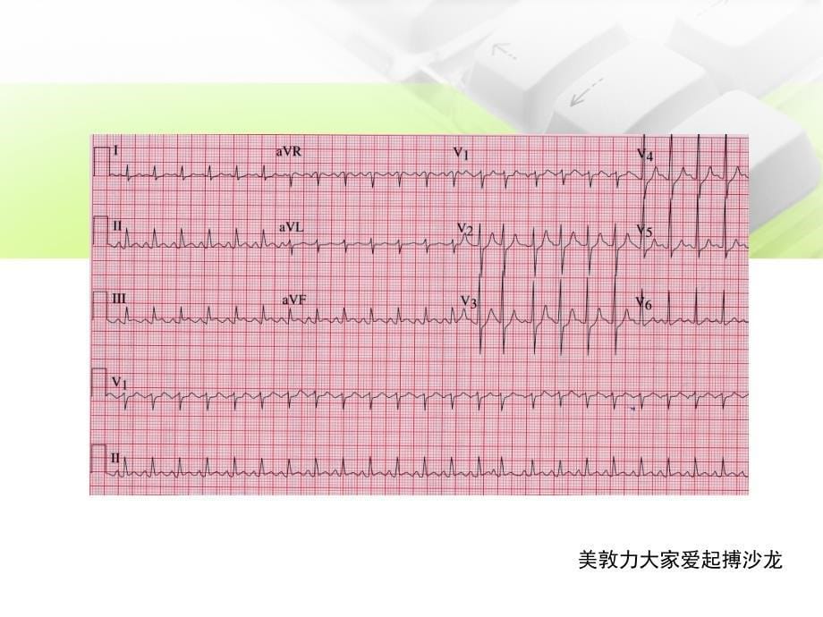 起搏心电图的分析课件_第5页