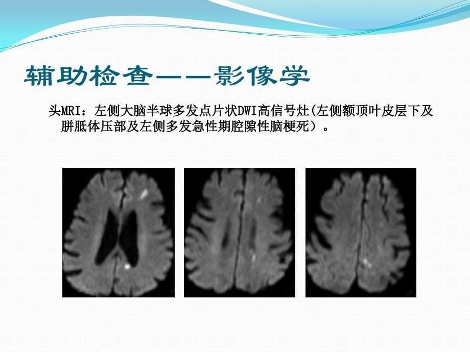 中国缺血性卒中亚型介绍课件_第5页