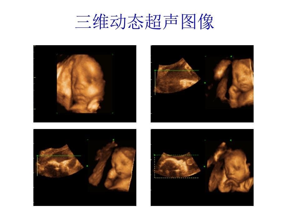 超声波超声诊断仪的物理原理课件_第5页