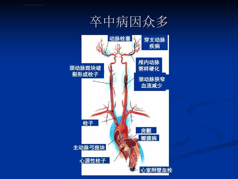 围手术期卒中防治课件_第5页