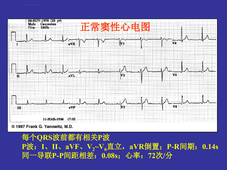 教学：心电图详解课件_第4页