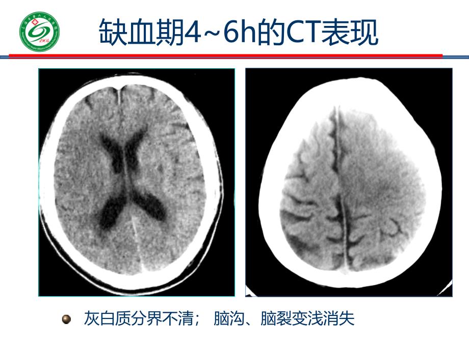 脑梗死多模式ct临床意义与解读课件_第4页