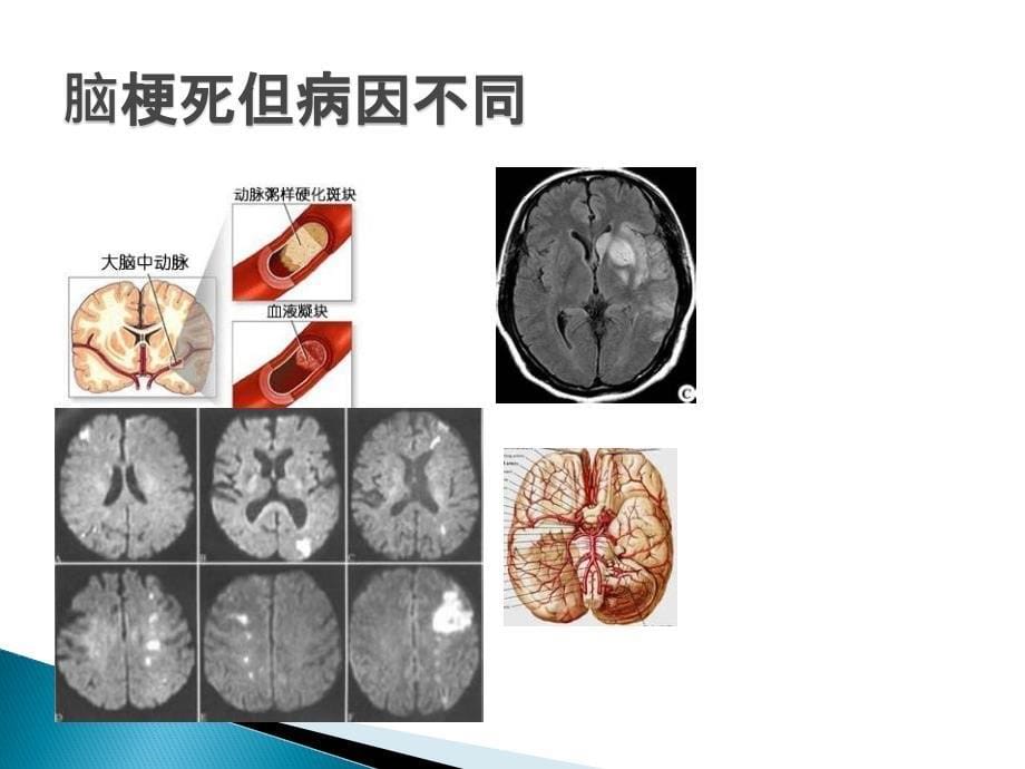 缺血性卒中的病因分型课件_第5页